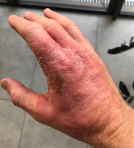 A Holistic Approach To Eczema - Ayurvedic Treatments And Procedures - The Ayurvedic Clinic