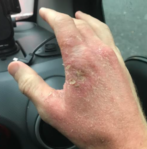 A Holistic Approach To Eczema - Ayurvedic Treatments And Procedures - The Ayurvedic Clinic