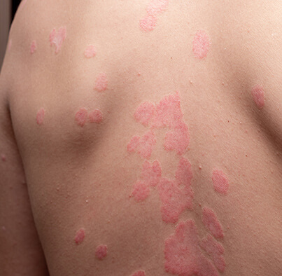 Psoriasis