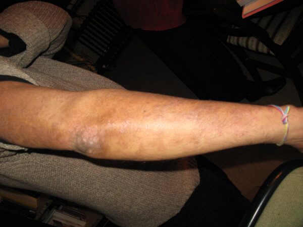 What Makes Ayurveda An Effective Treatment For Psoriasis? - The Ayurvedic Clinic What Makes Ayurveda An Effective Treatment For Psoriasis? - The Ayurvedic Clinic