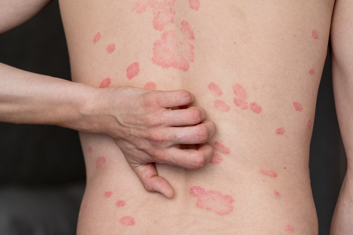 An Ayurvedic Approach to Managing Psoriasis