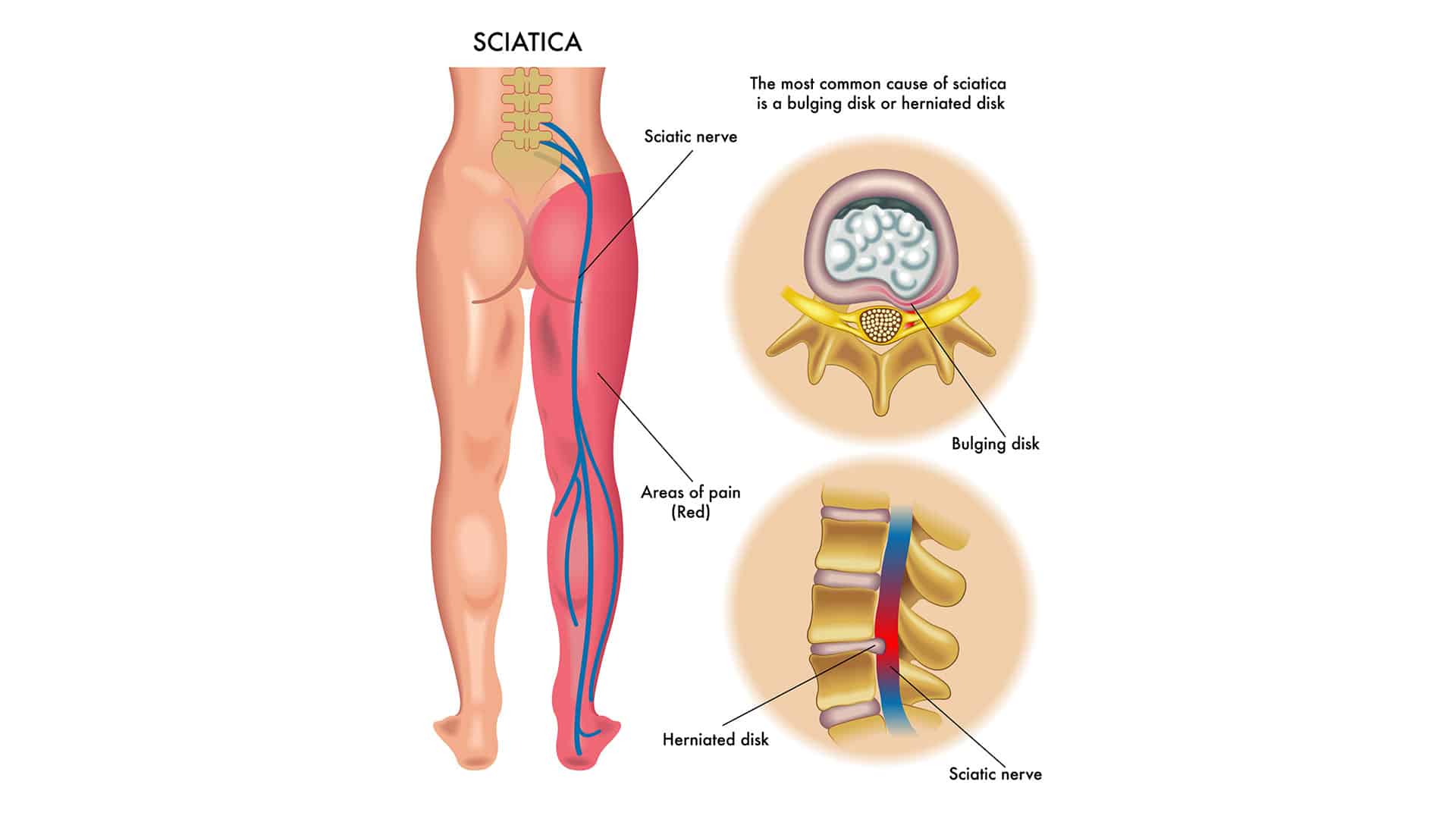 Are-These-Sciatica-Symptoms-Causing-Your-Pain Pain Management Clinic - The Ayurvedic Clinic