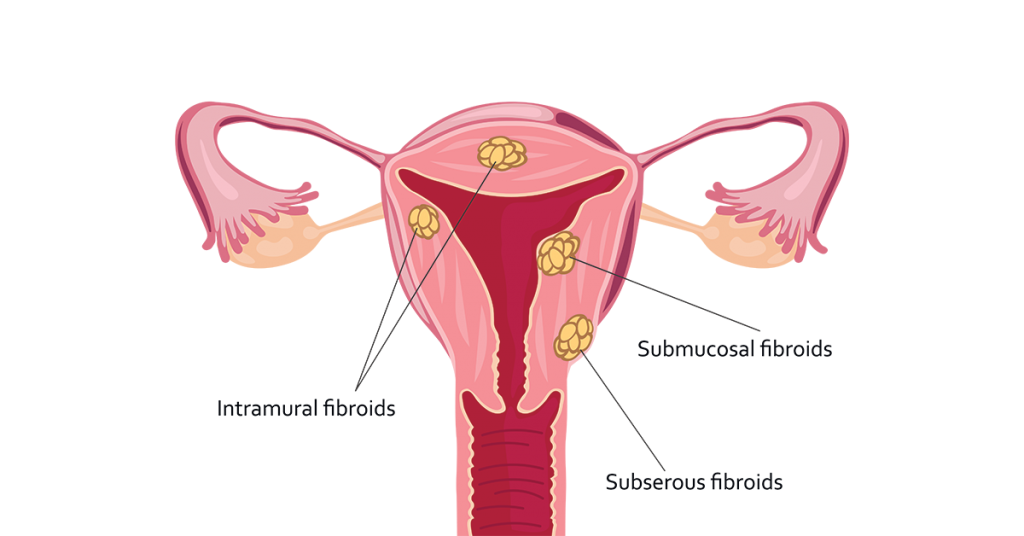 Gynecological Disorders - The Ayurvedic Clinic