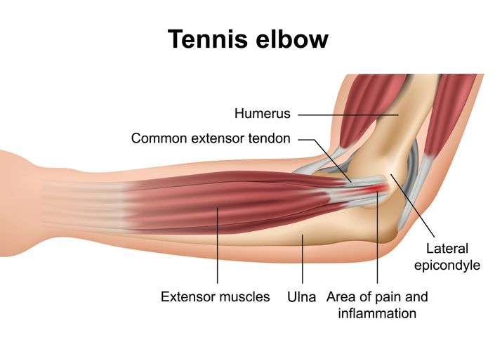 Tennis_Elbow Pain Management Clinic - The Ayurvedic Clinic