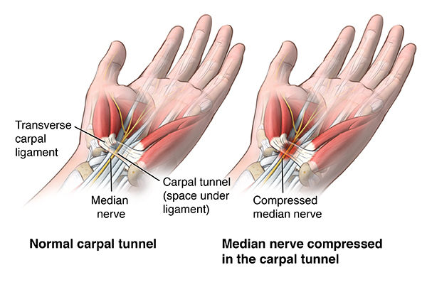 Anterior View Of Wrist Comparing A Healthy Carpal Tunnel With A Compressed Median Nerve In The Carpal Tunnel; Ortho_Carp-Tun-Rel-Endo_Anat Pain Management Clinic - The Ayurvedic Clinic