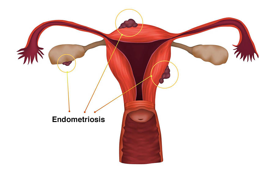 Gynecological Disorders - The Ayurvedic Clinic