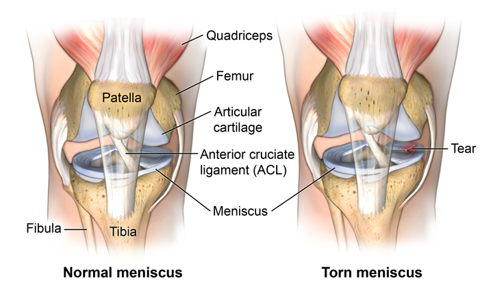 Normal And Torn Meniscus Pain Management Clinic - The Ayurvedic Clinic
