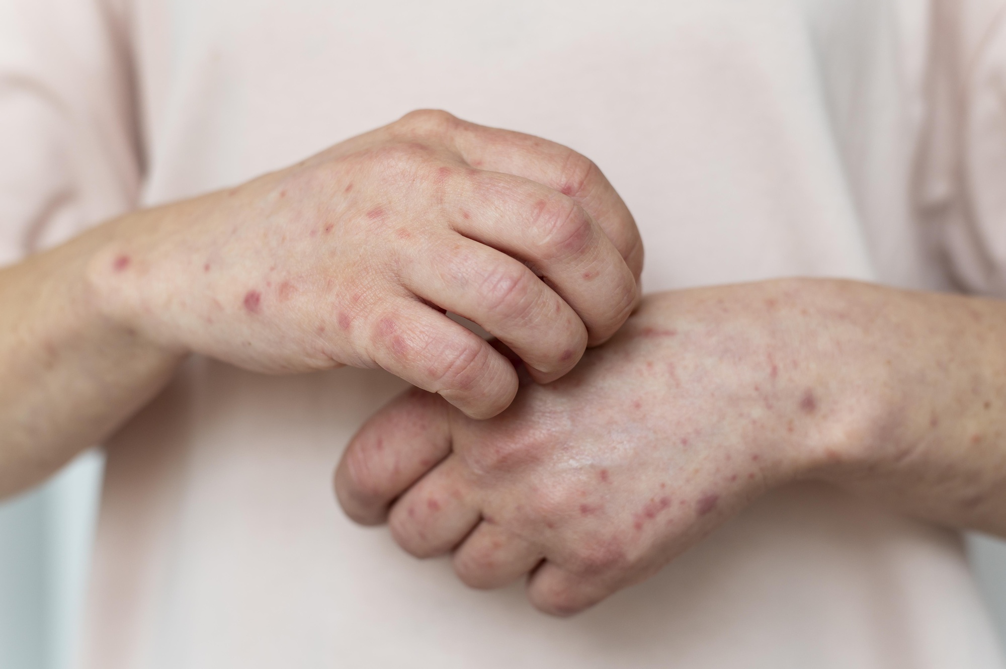 Skin Disorders - The Ayurvedic Clinic