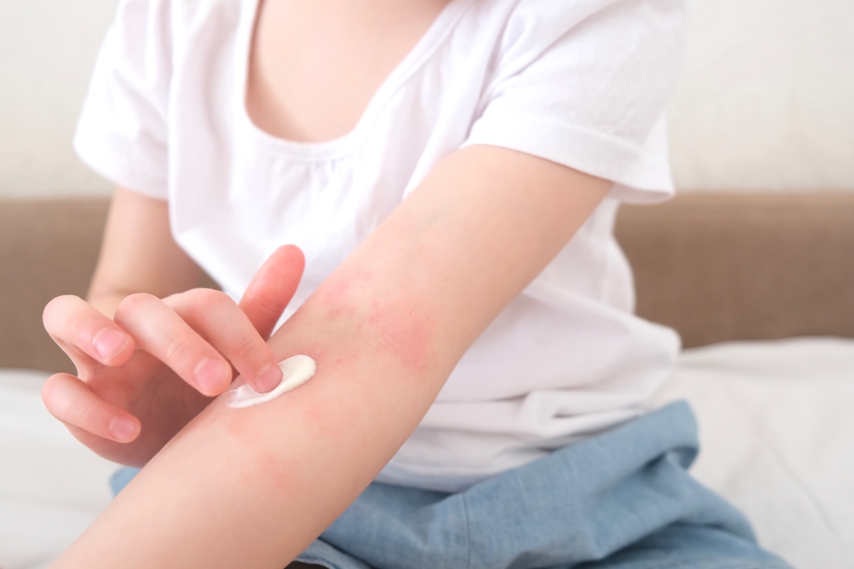 Ayurvedic Treatment for Eczema Prone Skin Ayurvedic Treatment for Eczema Prone Skin