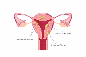 Ayurvedic Approach To Pcos - What To Expect During Treatment - The Ayurvedic Clinic